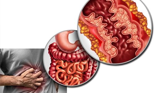 Crohn Hastalığı